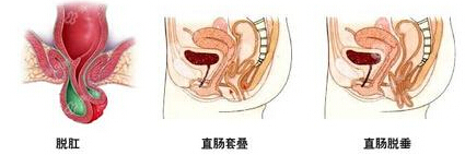 甚至出现表浅粘膜糜烂坏死,或脱垂肠段因肛门